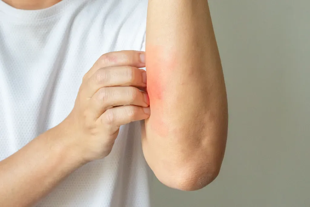 ​Łojotokowe zapalenie skóry